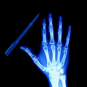 Xray image of a hand with a pen